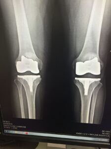 x-ray image of the author's replaced knees